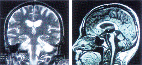 脳MRI